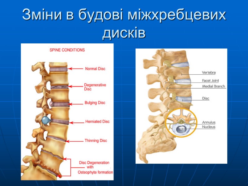 Зміни в будові міжхребцевих дисків
